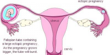 Ectopic pregnancy